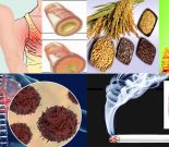 Ung thư phổi với nguyên nhân và biểu hiện các giai đoạn ung thư phổi