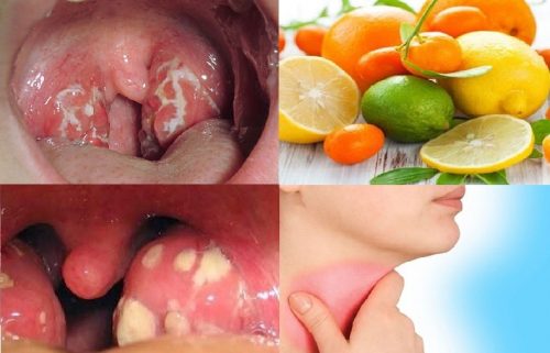 Ung thư vòm họng cần kiêng gì?