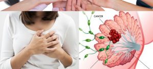 Ung thư vú với nguyên nhân và triệu chứng các giai đoạn bệnh