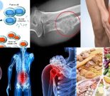 Ung thư xương và những vấn đề liên quan