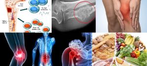 Ung thư xương và những vấn đề liên quan